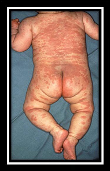 and SJS. Genital lesions may occur with Behçet's syndrome and primary syphilis. Some causes usually also have extraoral, cutaneous findings.