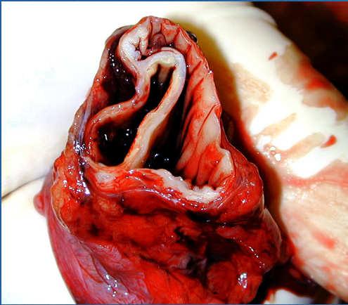 Aortic Dissection Ruptured