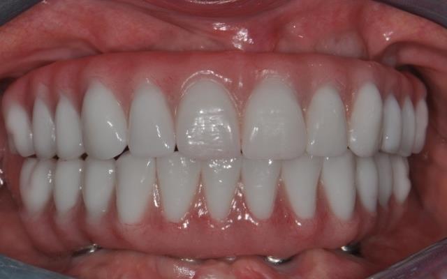 Patient Presentation/Chief Complaint: A 65-year-old female (non-smoker) presents on a 3 rd opinion with a history of medicationinduced xerostomia (MIX)-resulting in generalized recurrent caries and