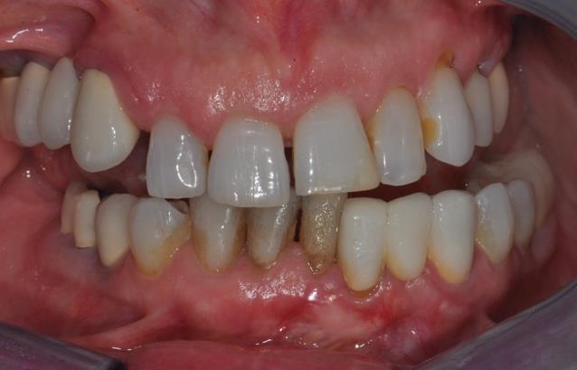 Her chief complaint was a desire to improve her esthetics and comfort and she wanted a quick, permanent solution to replace her failing dentitions.