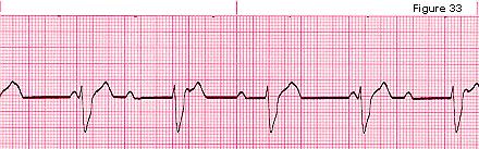 NCH Paramedic Education Program Page 6 b. More P waves than QRS complexes as atrial rate is usually faster c.