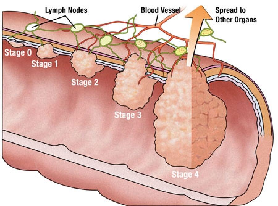 Cancer Staging Primary Tumor (T) Size and/or extent of the primary cancer/mass Regional Lymph Nodes (N) Spread to nearby lymph nodes Distant Metastasis (M) Spread of cancer to other parts of the body