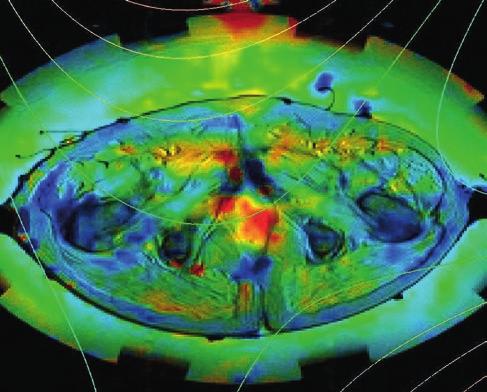 MRI Hyperthermia The new dimension MRI Hyperthermia MRI hyperthermia hybrid system Hybrid hyperthermia is a further technological development of regional deep hyperthermia, where a classic radiative