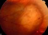 common primary intraocular malignancy in