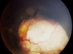 Retinoblastoma Staging: International classification of retinoblastoma (2003) is based on the rate