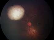 5 mm from optic disc and 3 mm from fovea Retinoblastoma International classification