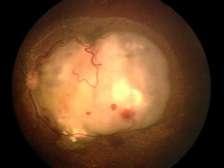 Retinoblastoma Group C: Any size tumor < ½ the eye Subtle