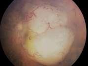 Diffuse or massive vitreous disease