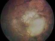 avascular tumor masses Wide Angle