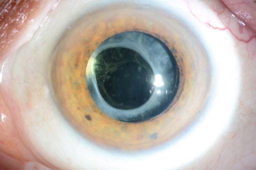 2. Cataract surgery