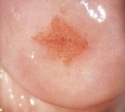 on the penis glans, and E) oral papilloma located on the base of tongue.