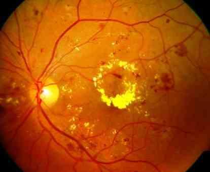 Diabetic retinopathy In diabetic retinopathy the blood vessels of the retina become abnormal and develop tiny leaks. These leaks cause fluid or blood to seep into the retina.