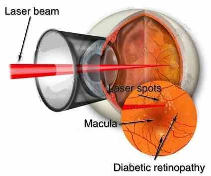 The laser heat seals the leaking blood vessels of the macula and reduces their leakage.