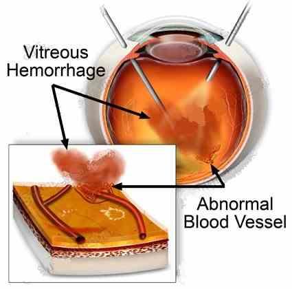 Vitreous haemorrhage and vitrectomy When a person does notice the sudden appearance of floaters, spider webs, spots in front of the eyes, or blurred vision, they should immediately call