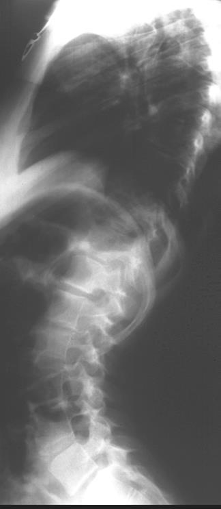 Radiographs- Standing Lateral view only if pain, lordosis, kyphosis or needs treatment 2-3X the radiation
