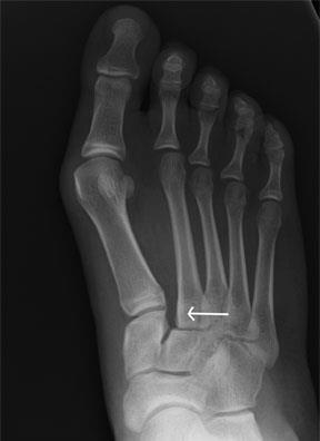Charcot Foot: Diagnosis Clinical Exam +Rubor +Tumor +Calor