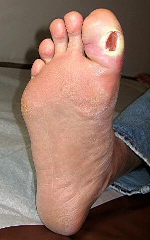 Diabetic Foot Ulcers: