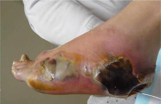 Diabetic Foot Ulcers: Staging & Treatment Grade