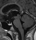 Juvenile pilocytic astrocytoma (JPA) - Ependymoma Additional Diagnostic Consideration: - Brainstem glioma - Atypical teratoid rhabdoid tumor (rare) Diagnosis: Ependymoma Medulloblastoma High grade