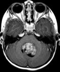 61 62 Medulloblastoma Post-contrast T1 MR images show: CSF metastases along surface of cerebellum, brainstem, &