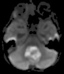 posterior fossa tumor in children Peak incidence 5-15 years of age May occur sporadically or with NF1 Arises from
