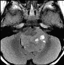 Ependymoma MR images in a boy with an ependymoma show: Enhancing midline mass with extension thru foramen magnum Extension thru foramen of Luschka on left Brainstem Glioma Represents ~10-20% of