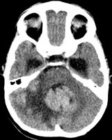 Prognosis dismal (mean survival <6 months) 69 70 Atypical Teratoid Rhabdoid Tumor 2-yr-old girl with ATRT Axial CT shows: Hyperdense midline posterior fossa mass Vasogenic edema Obstructive