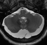 morphology Typically no mass effect on subjacent parenchyma May see mild mass effect due to altered CSF flow Vessels & dural reflections seen within cisterna