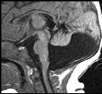 fossa Vermian agenesis or hypogenesis Posterior CSF collection communicating with