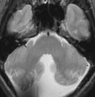 collection Dandy-Walker Malformation Posterior fossa CSF collection Differential