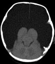 parenchyma Aqueductal stenosis Massive supratentorial CSF collection Hydranencephaly Refers to parenchymal liquefactive necrosis in anterior vascular distribution Results from some form of