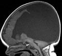 Massive supratentorial CSF collection Alobar Holoprosencephaly Massive supratentorial CSF collection Differential Diagnosis Review - Hydrocephalus - Hydranencephaly - Alobar holoprosencephaly MR
