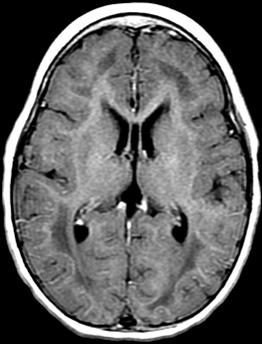 Adolescent Confluent white matter disease in a child - Multiple sclerosis (MS) - Acute disseminating encephalomyelitis (ADEM) - Dysmyelinating disease (leukodystrophy) Additional Diagnostic