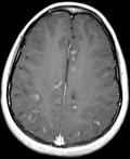 disease in a child Multiple sclerosis (MS) Young girl with advanced MS Numerous white matter lesions; active lesions demonstrate peripheral nodular and ring-enhancement along leading edge 15 16