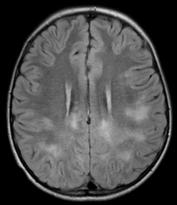 from self-limiting to fulminant encephalitis MRI reveals bilateral T2 bright white matter lesions Often similar distribution & morphology to MS Periventricular Corpus callosum Posterior fossa /