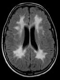 Confluent white matter disease in a child Dysmyelinating Disease Leukodystrophies result in dysmelination Enzyme deficiencies cause accumulation of toxic metabolites Affects myelin formation & repair