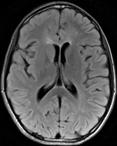 Toxic Encephalopathy Confluent white matter lesions in a child Toxic Encephalopathy Chemotherapy may result in: Relatively symmetric WM signal abnormality May involve cerebrum (incl corpus callosum),
