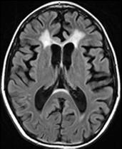 germinoma Pre-treatment FLAIR image is normal Post-treatment FLAIR image shows symmetric confluent WM hyperintensity including the CC Pre-treatment Post-treatment 21 22 Confluent white matter lesions