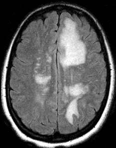 Confluent white matter lesions in a child Atypical Infection Confluent white matter disease in a child Differential Diagnosis Review Young adult man with AIDS and PML FLAIR