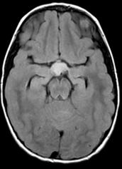 disease (leukodystrophy) Additional Diagnostic Considerations: - Toxic leukoencephalopathy (chemo/radiation) - Atypical infection (PML, HIV) *Image courtesy of Paul Sherman, M.