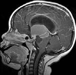 Craniopharyngioma Craniopharyngioma 9-yr-old boy with cystic and solid suprasellar mass Some