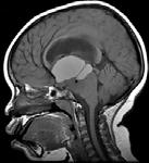 headaches CT shows a calcified sellar/suprasellar mass 31 32 Germ Cell Tumor GCTs most common in