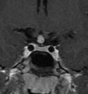 Sagittal T1 images in a patient with a germinoma show: Infiltrative sellar/suprasellar mass-
