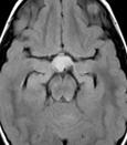 Hypothalamic Hamartoma Hypothalamic hamartomas are rare, benign lesions Children