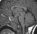 Hamartoma MRI in a 3-yr-old boy with precocious puberty shows: T2 hyperintense