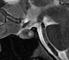curvilinear wall calcifications on CT Lesions with high mucin content are T1
