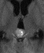 germinoma Axial CT image reveals: Hyperdense pineal mass Central calcifications Germ Cell Tumor 49 50 Pineal Cell Tumor Pineoblastomas more