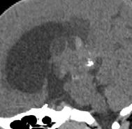 Generally less aggressive Both hyperdense on CT due to high cellularity Calcifications occur along periphery in exploded pattern Lesions ae