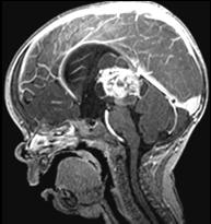 Sagittal CT reveals: Large lobulated mixed cystic and solid pineal mass Peripheral calcification Obstructive hydrocephalus 51 52 Pineal Cell