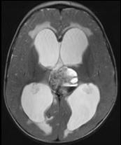 transependymal flow of CSF Tectal Plate Glioma Tectal plate gliomas are low-grade neoplasms May cause hydrocephalus due to aqueductal